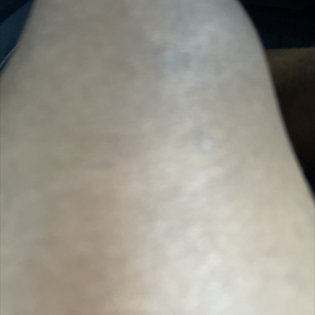 My leg 